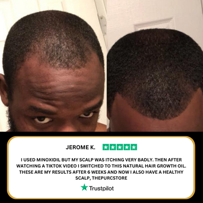 The (VIRAL) Purc™ Natural Hair Growth Oil